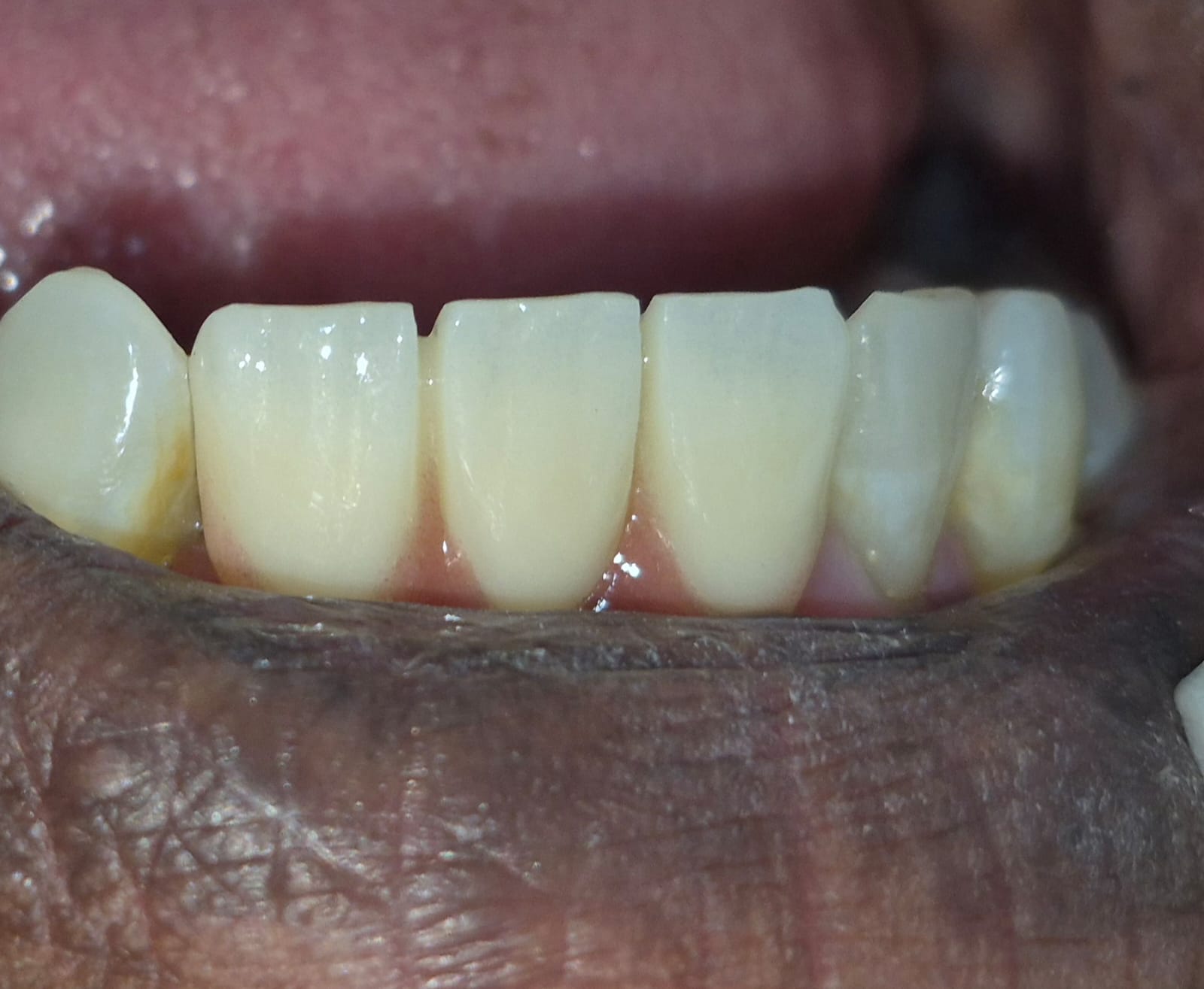 After fixed dental bridge for missing lower front teeth at Smile Story Dental Clinic, Madurai