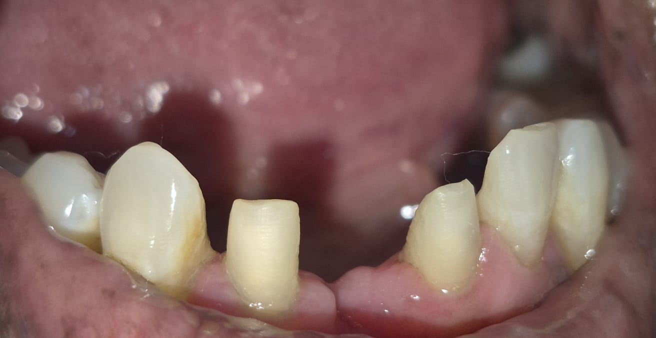 Before fixed dental bridge for missing lower front teeth at Smile Story Dental Clinic, Madurai