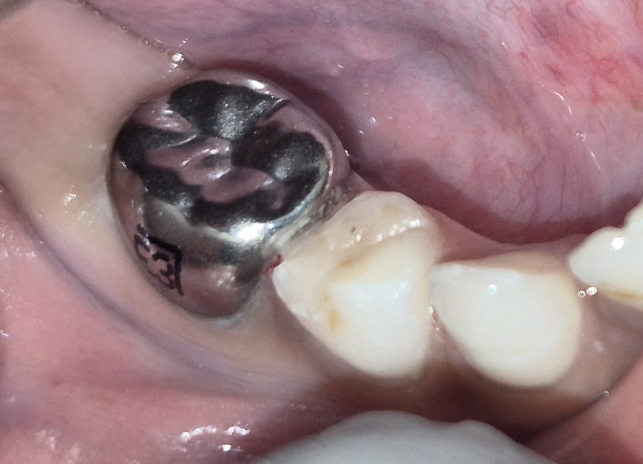 After metal crown restoration for decayed molar at Smile Story Dental Clinic, Madurai