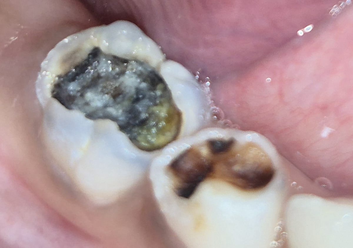Before metal crown restoration for decayed molar at Smile Story Dental Clinic, Madurai